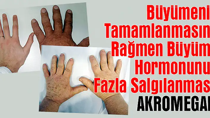 Büyümenin Tamamlanmasına Rağmen Büyüme Hormonunun Fazla Salgılanması: Akromegali